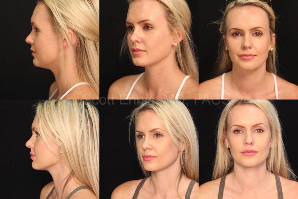 Kybella to the neck 32 yof Before and After Ennis Plastic Surgery Palm Beach Boca Raton Destin Miami 13848 (4)